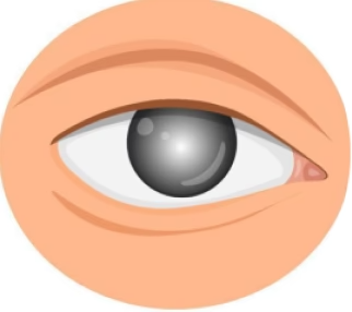 imgi 19 Cloudy-or-blurred-vision 7c10e137-ac03-4ec5-ba4f-4e5cbe9282c2